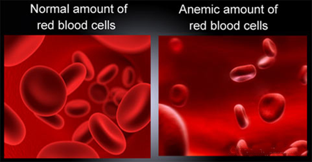 Image result for anaemia images